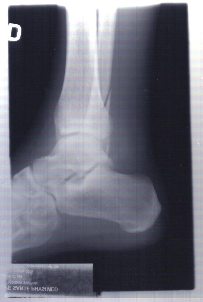 fracture01-small.jpg